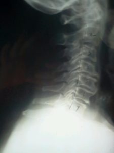 untreated whiplash injury x-ray